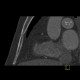 Sternal foramen: CT - Computed tomography